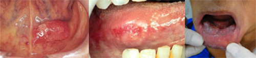 Carcinoma de células escamosas em base, lateral de língua e lábio inferior. Geralmente associadas a hábitos e fatores de risco como o tabagismo e o alcoolismo.