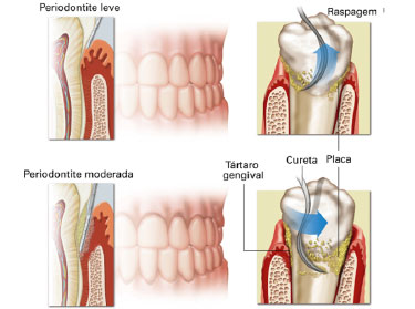 Raspagem sub gengival ou terapia periodontal