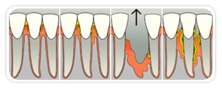 Stages of periodontal disease