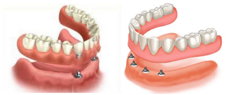 Overdentures ou dentaduras sobre implantes